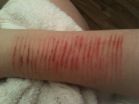 Cuts